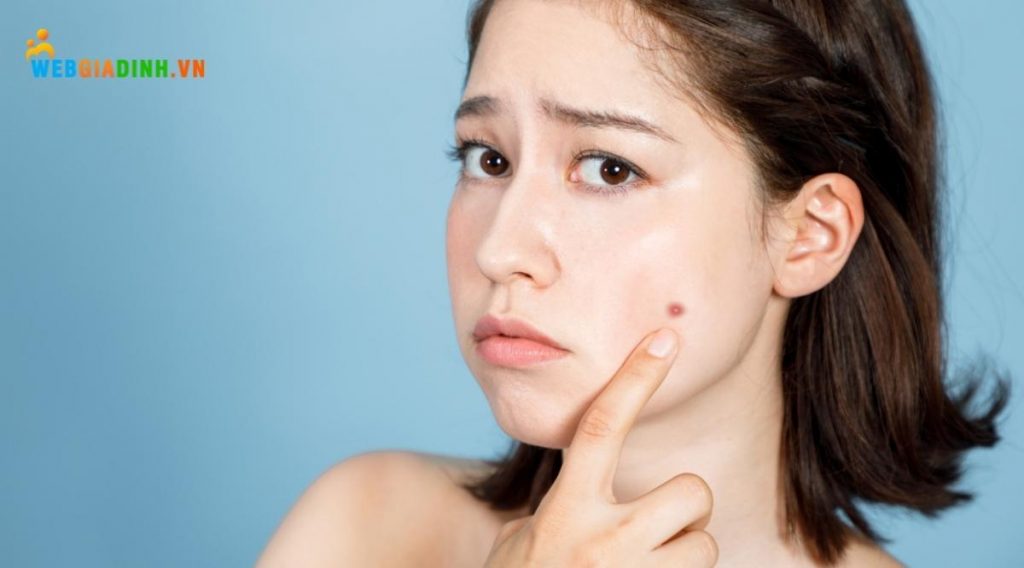 mụn ở tuổi dậy thì